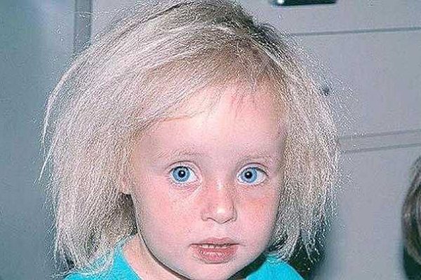600uncombable-hair-syndrome-14AABB80757088F1C21
