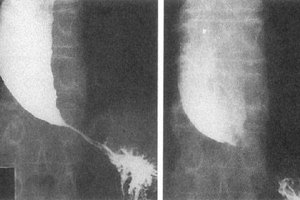 Achalasia-Picture