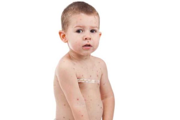 Smallpox-In-Children