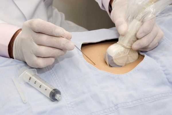 ultrasound-biopsy
