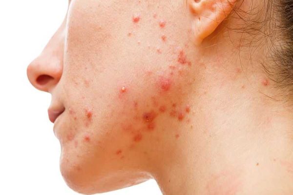 acne vulgaris