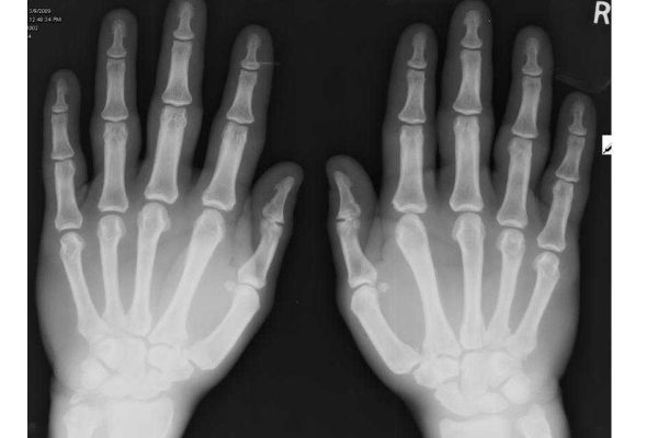 acromegaly
