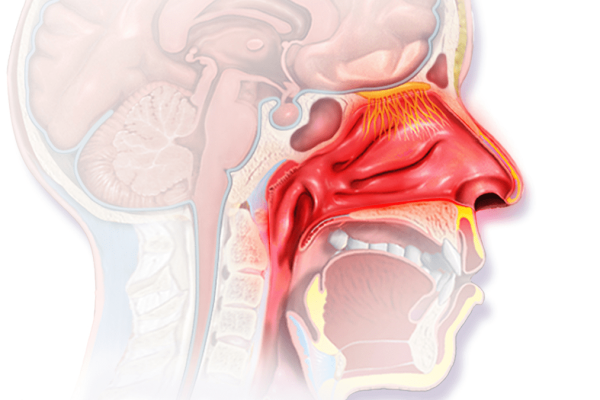 allergicrhinitis