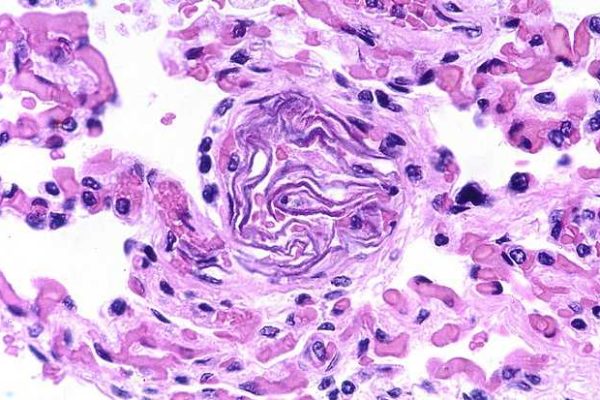 amniotic embolism