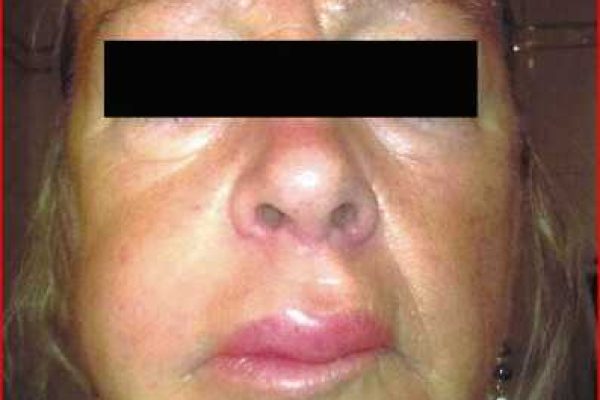 angioedema