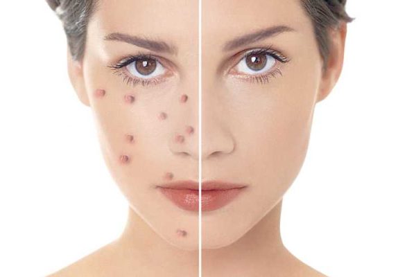 derma