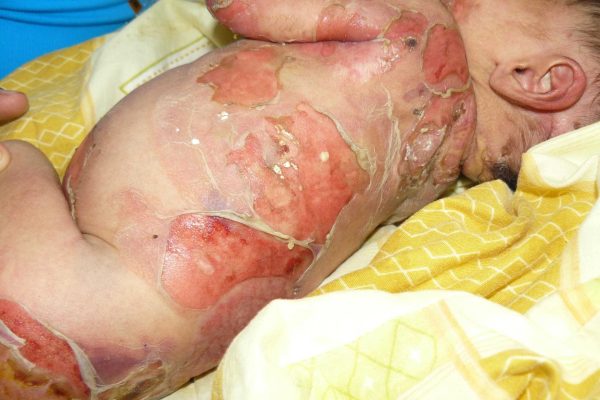 epidermolysis-bullosa