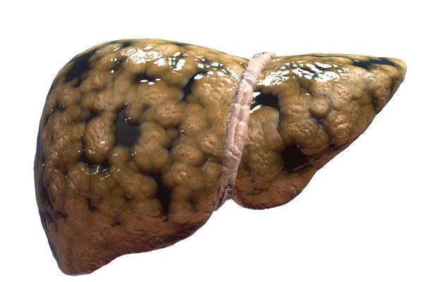 fatty-liver
