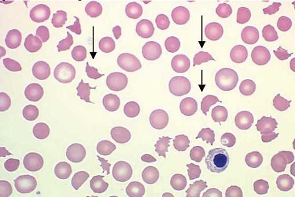 hematologysfig1_large