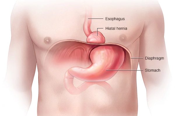 hiatalhernia