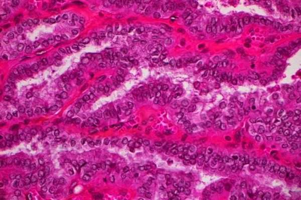 jpg_thyroid_papillary_carcinoma_12_1
