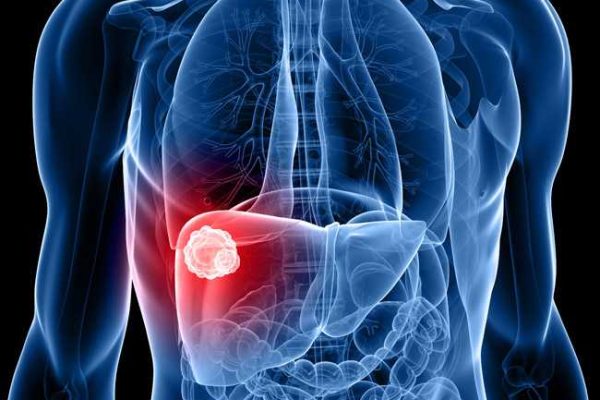 liver tumour