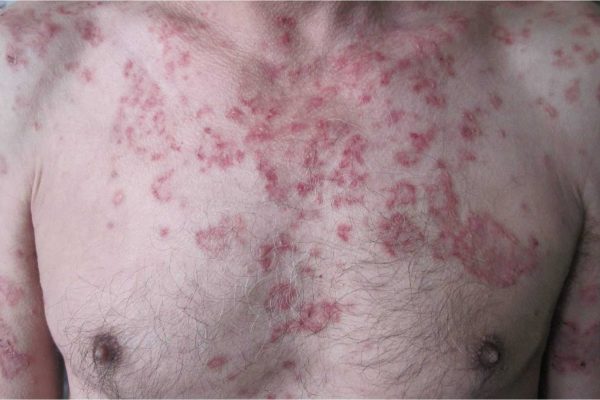 lupus