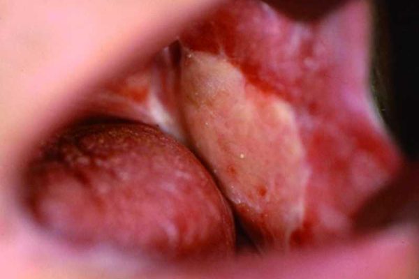 oral_cancer_squamous_cell_800x600