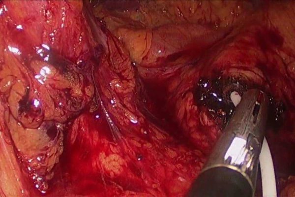 pancreaticlaparoscopicresection