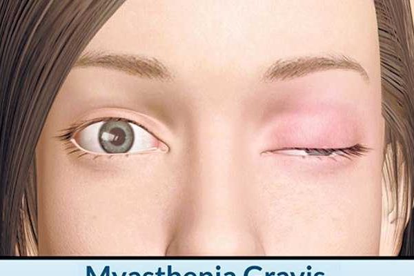 penyakit-miastenia-gravis