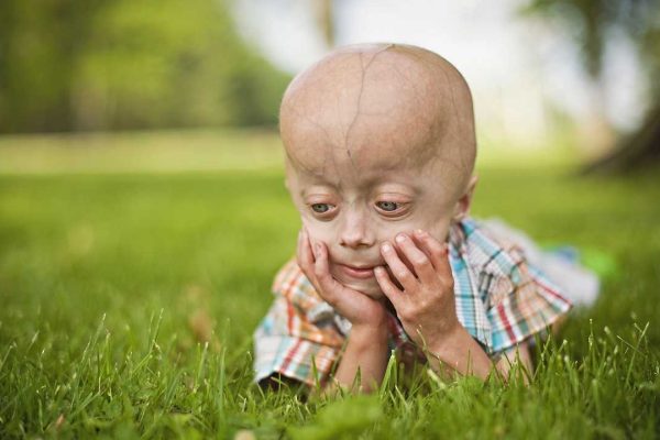 progeria child