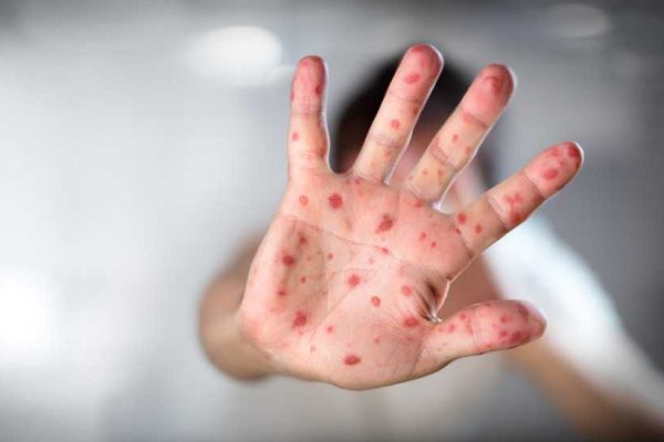 smallpox