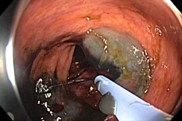 tatooendoscopic