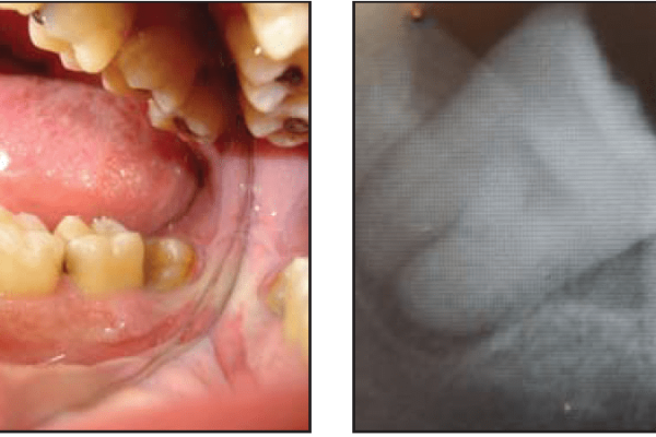 tooth