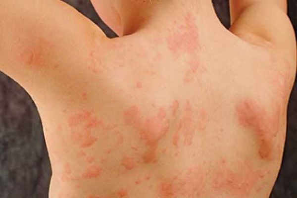urticaria